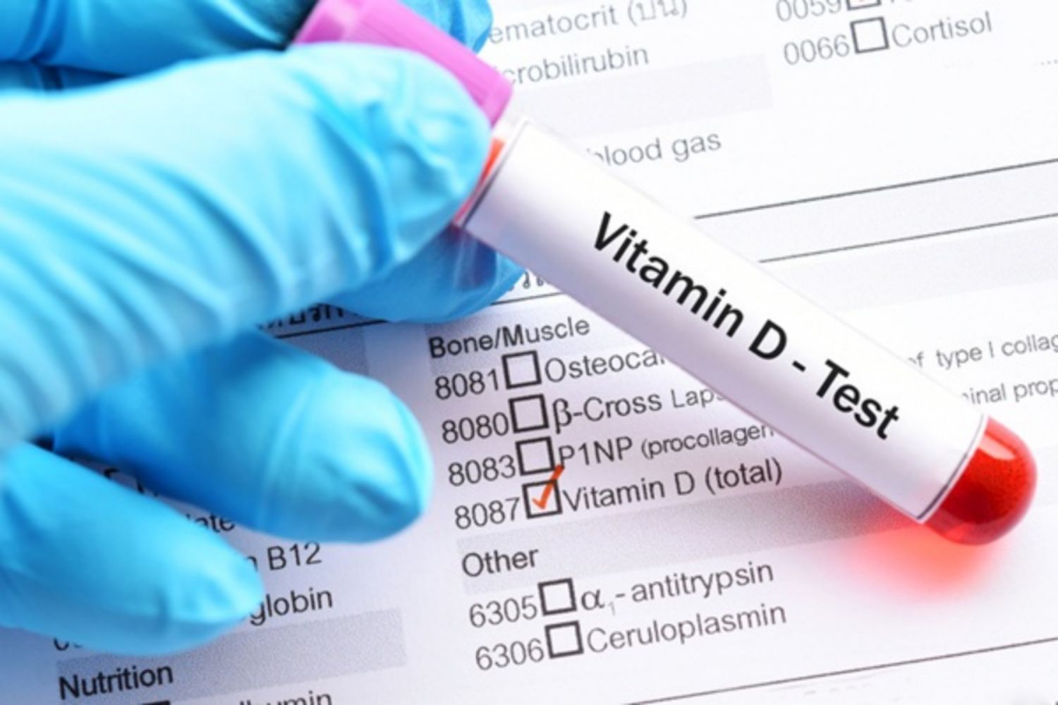 Những điều cần biết về xét nghiệm 25-hydroxyvitamin D